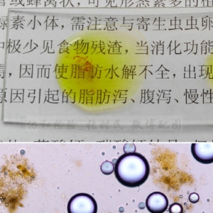 粪便镜检之脂肪滴