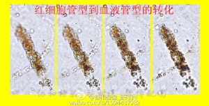 红细胞管型到血液管型的转化