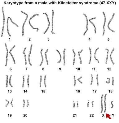 深入解读：胎儿医学之胎儿染色体异常的产前诊断