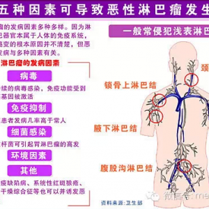 哪类人易患淋巴瘤 ？