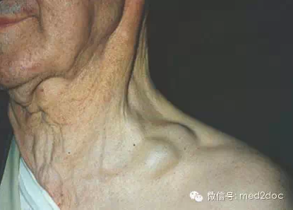 哪类人易患淋巴瘤 ?