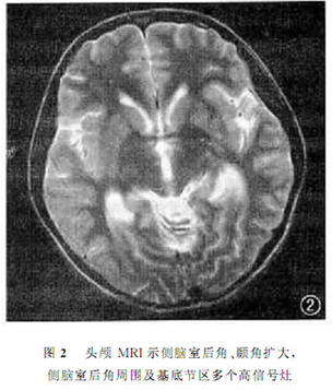 肺炎支原体脑炎的诊断与治疗