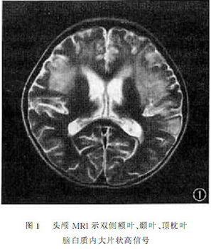 肺炎支原体脑炎的诊断与治疗