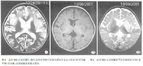 肺炎支原体脑炎的诊断与治疗