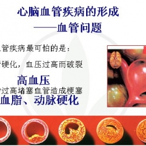 未来10年，你的心脑血管病风险是多少？