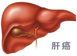 佑安医院专家肝癌标志物研究获国际专利