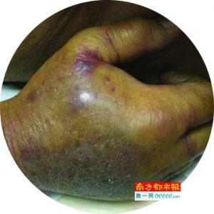 七旬老人被蟹钳夹伤 感染食肉菌不治身亡