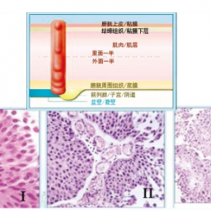 膀胱肿瘤概述
