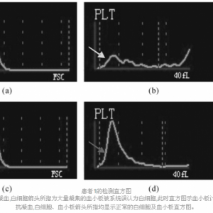 EDTA依赖性假性血小板减少的实验室解决思路