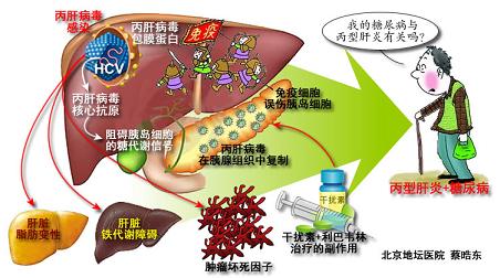 蔡晧东：为什么丙型肝炎患者容易得糖尿病？
