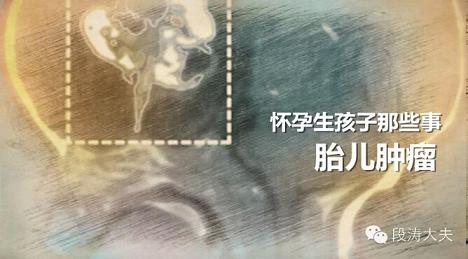 怀孕生孩子那些事之胎儿肿瘤