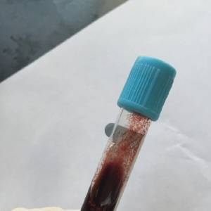 严重的冷凝集应该怎么办？