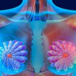 三阴性乳腺癌的一个突破口——BRCA基因检测？
