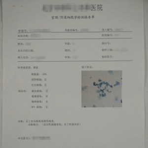 解读TCT这个妇科“侦探”
