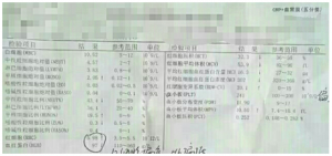 【检验临床面对面】从血小板直方图知道背后的真相