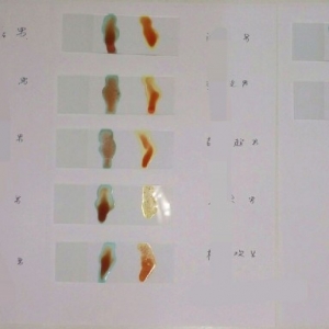 【检验临床面对面】 组团查血型？