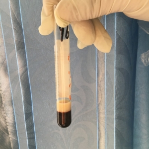 【检验临床面对面】检验结果都这样了，还不该引起重视吗？ ... ...