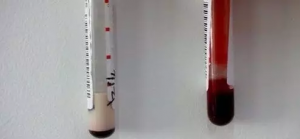 如果你经常这么吃 抽出来的血会是奶白色的