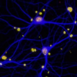 BRCA1：除了是乳腺癌易感基因，还与阿尔兹海默症有关联