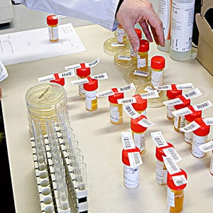 尿液替代血液一步检测HCV