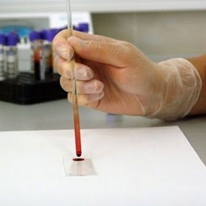 日本科学家发现白血病的致病基因