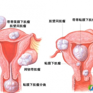 GWAS分析确定的五种子宫内膜癌高风险基因