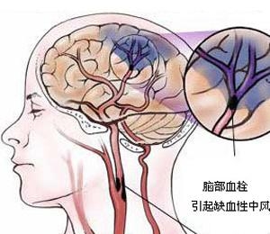 脑血栓易致死致残 照着做脑血栓一扫而光!
