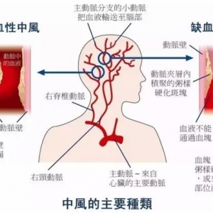 你离中风有多远？危机早已潜伏，算算你的发病系数吧