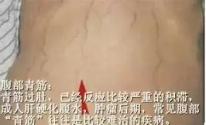 这个部位“青筋暴突”，可能你的肝已经硬化