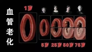 这根血管最容易堵，很多人半身不遂之后才发现！