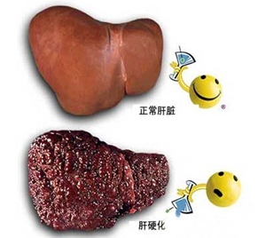 肝硬化发生的八个因素 小心肝硬化这些并发症