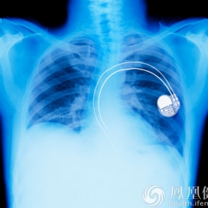 拍胸片为何不能发现早期肺癌